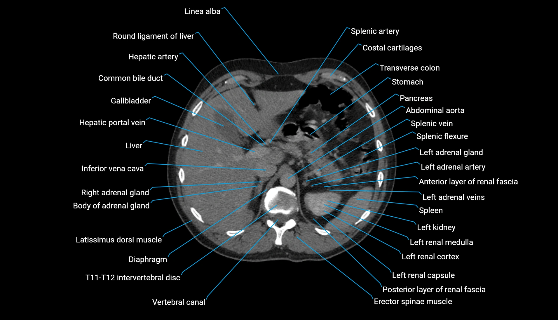 CT urogram axial cross sectional anatomy  labelled radiology image-00073.webp